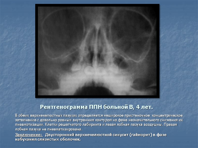 Рентгенограмма ППН больной В, 4 лет. В обеих верхнечелюстных пазухах определяется неширокое пристеночное 